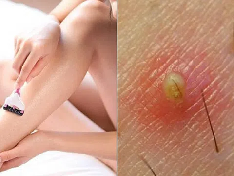 Cách trị viêm lỗ chân lông ngay tại nhà