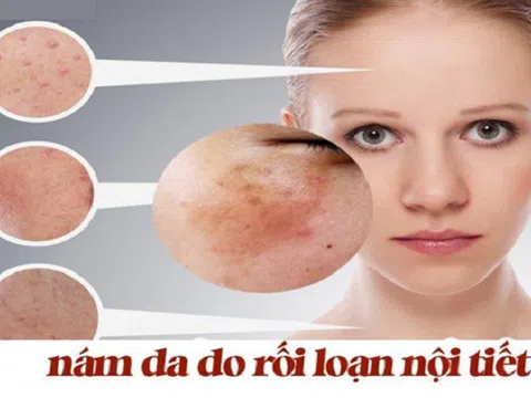 Phân biệt nám nội tiết tố và nám môi trường. Đâu là giải pháp trị nám hiệu quả