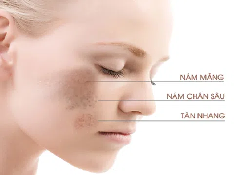 Tàn nhang nám cũng phải 'chào thua' khi bạn dùng tuyệt chiêu này