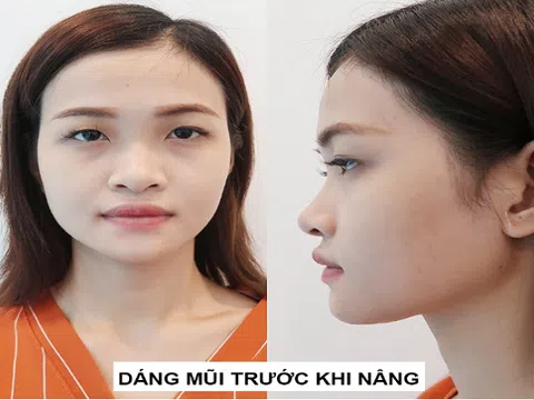 Nhờ nâng mũi phong thủy - Cô nàng 'Ẵm ngay' danh hiệu nữ hoàng quyến rũ