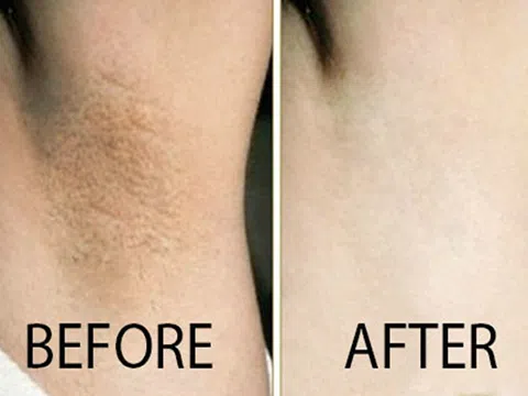 Bà đẻ stress vì bị thâm nách, hôi nách sau sinh