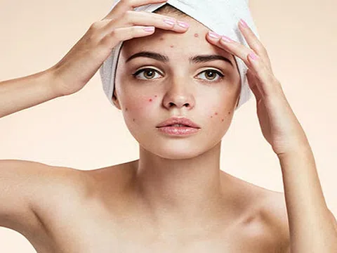 Thiết lập chế độ ăn uống sinh hoạt cho người bị mụn