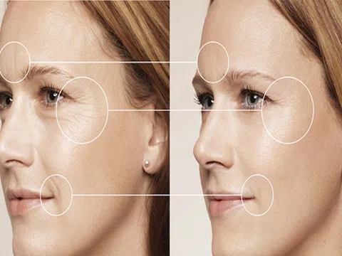 Tại sao bạn nên can thiệp da lão hóa bằng công nghệ Thermage?