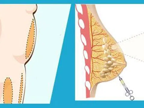 Tìm hiểu phương pháp nâng ngực chảy xệ không cần phẫu thuật