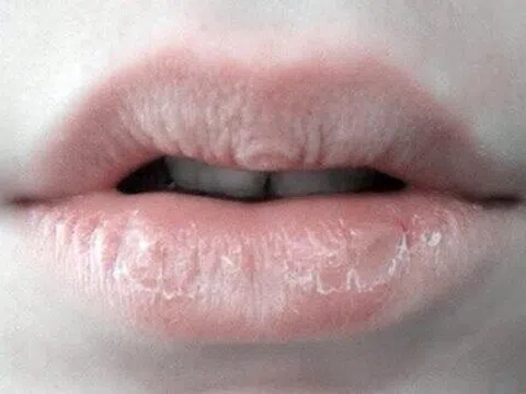 Bác sĩ Ngô Kiều Khanh chỉ ra giải pháp an toàn cho môi khô, nứt nẻ