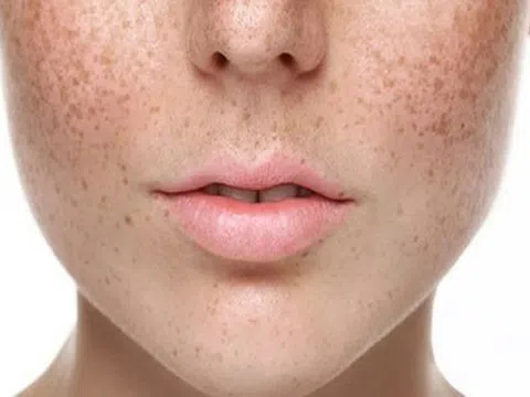 Thai kỳ ảnh hưởng như thế nào đến làn da của bạn?