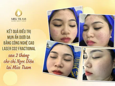 Cách làm mặt nạ lột mụn đầu đen hiệu quả tại nhà