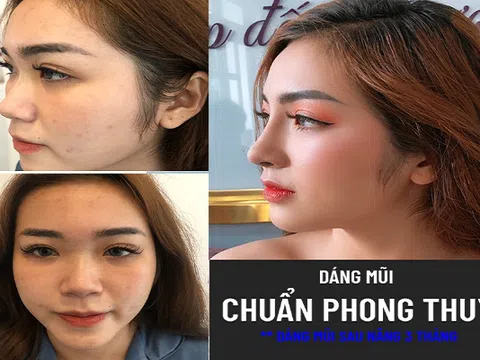 Nâng mũi phong thủy theo góc nhìn từ Ths. Bác sỹ Trần Quang Long