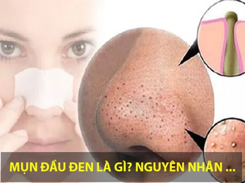 Hiểu rõ về mụn đầu đen và cách chăm sóc hiệu quả