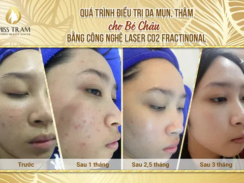 Những lưu ý khi sử dụng tỏi tươi trị mụn