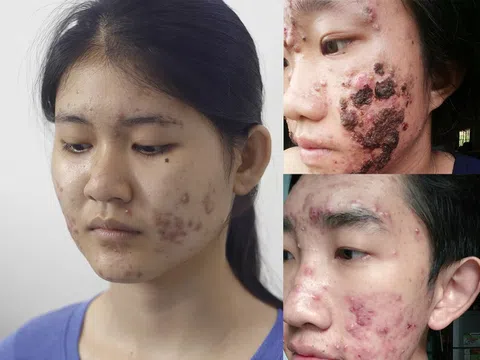 Những 'thủ phạm' gây ra mụn và cách chữa trị dứt điểm