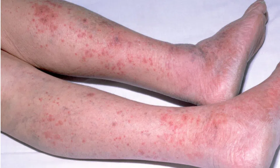 Viêm não mô cầu: Căn bệnh nguy hiểm có thể gây tử vong trong 24 giờ xuất hiện tại Hà Nội